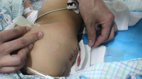 湖南尾巴男嬰手術(shù)很成功 不切除小尾巴可致癱瘓