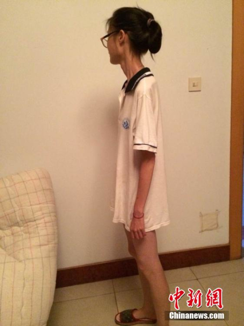 女孩過度節(jié)食導(dǎo)致閉經(jīng)