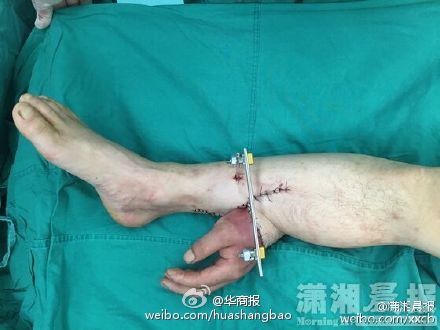 現實版寄生手掌