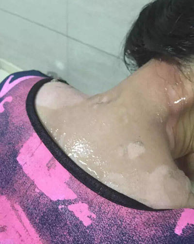 女子遭服務(wù)員潑熱湯