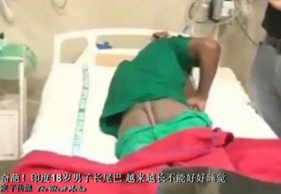 18歲男子長尾巴