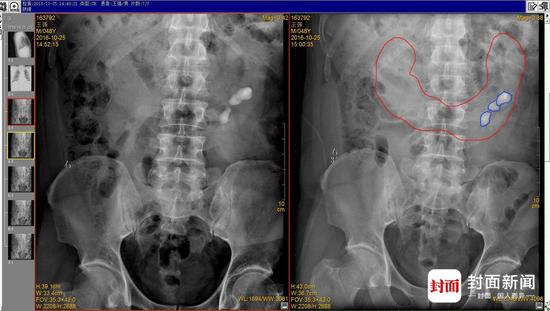 男子長U形馬蹄腎