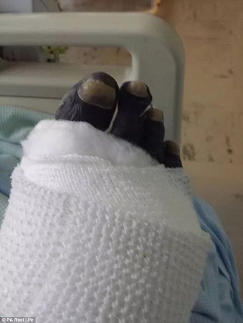 被愛犬舔舐后截肢