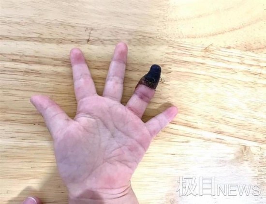家人錯(cuò)誤包扎致3歲女童手指壞死