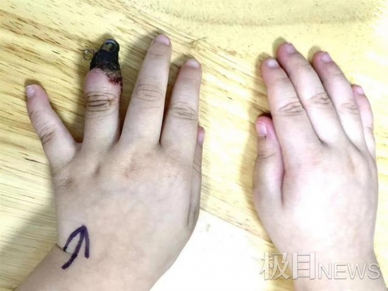 家人錯(cuò)誤包扎致3歲女童手指壞死